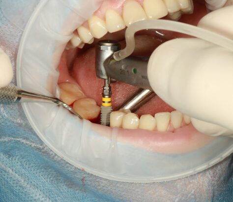 implanturi dentare craiova cnc dental care